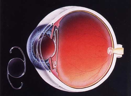 lens-implant